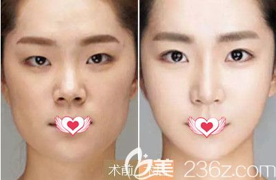 吳長國醫(yī)生做隆鼻手術(shù)案例 吳長國醫(yī)生做隆鼻手術(shù)案例