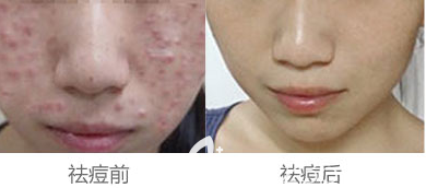 北京華韓陳敏醫(yī)生祛痘美膚案例 北京華韓陳敏醫(yī)生祛痘美膚案例