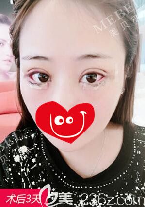 做完眼綜合手術(shù)術(shù)后三天兩邊眼睛寬度不一 做完眼綜合手術(shù)術(shù)后三天兩邊眼睛寬度不一