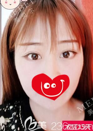 南京美貝爾分享眼綜合術(shù)后半個月恢復(fù) 南京美貝爾分享眼綜合術(shù)后半個月恢復(fù)