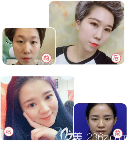 汕頭華美整形醫(yī)院田學(xué)勤雙眼皮案例