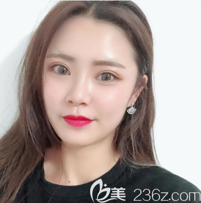 我看朋友找汕頭華美田學(xué)勤主任做的雙眼皮挺好看的就去做了同款