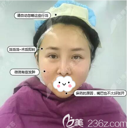 成都恒博線雕術(shù)后即刻效果 成都恒博線雕術(shù)后即刻效果