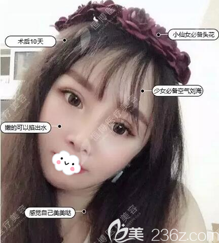 埋線提升術(shù)后10天恢復(fù)照 埋線提升術(shù)后10天恢復(fù)照