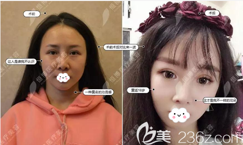成都恒博牟燕萍線雕提升術(shù)前術(shù)后對(duì)比照片 成都恒博牟燕萍線雕提升術(shù)前術(shù)后對(duì)比照片
