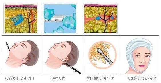 面部吸脂手術(shù)原理