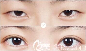 李院長(zhǎng)做切開雙眼皮+開內(nèi)眼角術(shù)后對(duì)比