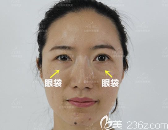 在<!--<i data=20240703-sp></i>-->整形祛眼袋手術(shù)前 在<!--<i data=20240703-sp></i>-->整形祛眼袋手術(shù)前