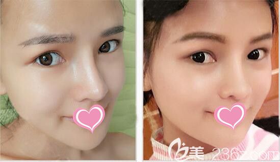 福州臺江鼻綜合整形案例