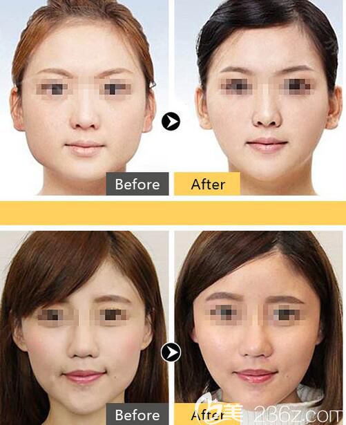 福州臺江注射瘦臉效果對比