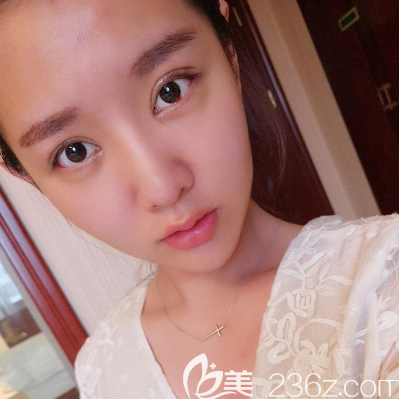 東莞華美雙眼皮案例7天拆線