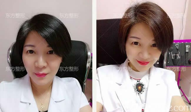 這是我在南寧東方整形做全臉線雕提升7天恢復(fù)圖，真實(shí)感受至少年輕10歲