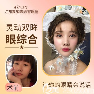 廣州壹加壹項美蓮雙眼皮案例
