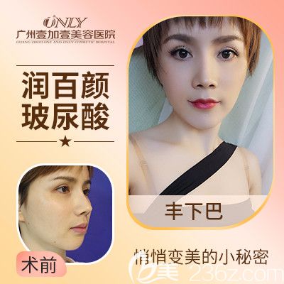 廣州壹加壹潤百顏玻尿酸豐下巴案例