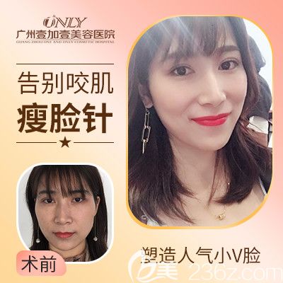 廣州壹加壹整形美容醫(yī)院瘦臉案例
