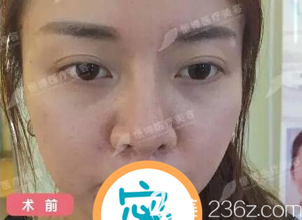 隆鼻失敗后我準(zhǔn)備嘗試鼻修復(fù)手術(shù) 隆鼻失敗后我準(zhǔn)備嘗試鼻修復(fù)手術(shù)