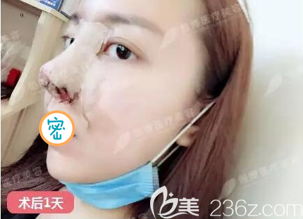半肋鼻綜合術(shù)后即刻照片 半肋鼻綜合術(shù)后即刻照片