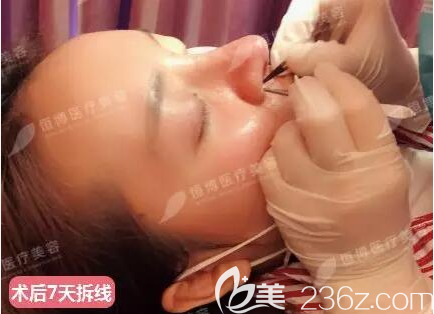 膨體+肋軟骨鼻綜合術(shù)后7天拆線 膨體+肋軟骨鼻綜合術(shù)后7天拆線