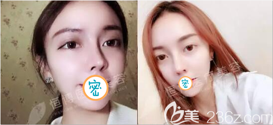 肋軟骨鼻綜合術(shù)后8個月美照 肋軟骨鼻綜合術(shù)后8個月美照