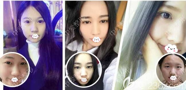 黃石中愛萬文勇雙眼皮案例效果對比圖