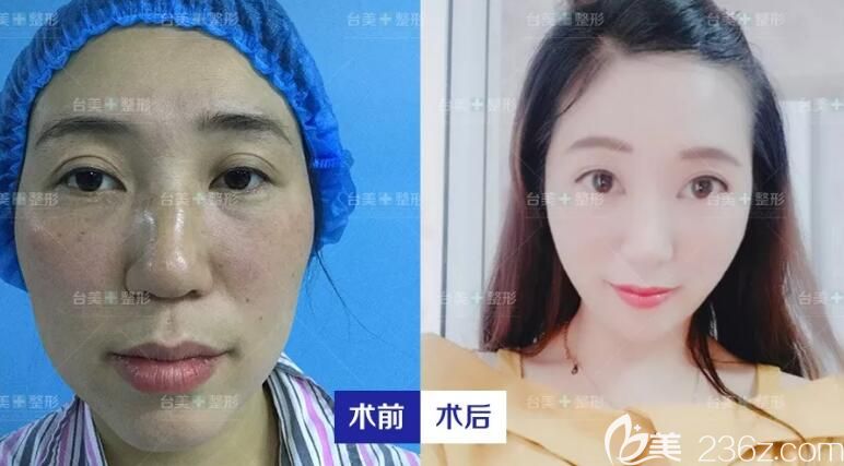 王新磊整形怎么樣？坐診合肥臺美期間整形案例圖片公布