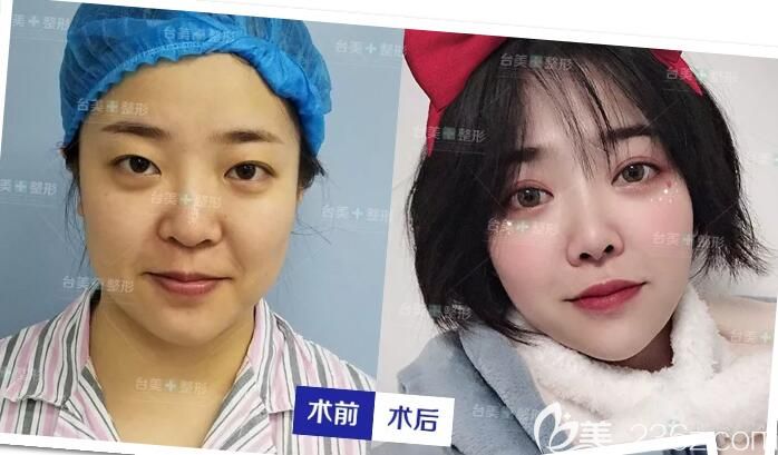 王新磊眼綜合鼻綜合整形案例