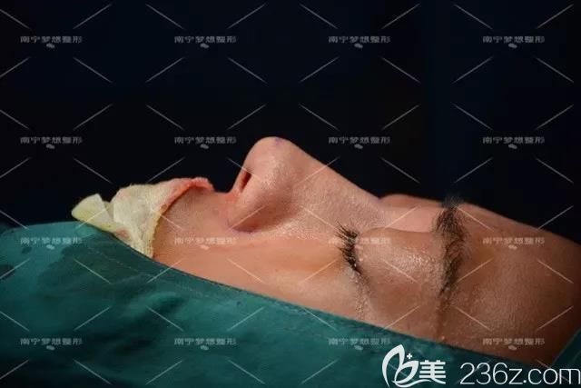 南寧夢想唐超給我做鼻綜合和豐下巴術(shù)后即刻