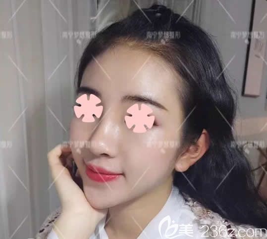我在南寧夢想整形做鼻綜合和墊下巴術(shù)后第7天