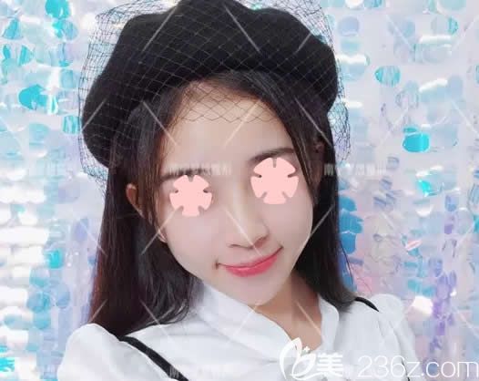  速來圍觀:我一個(gè)月前找南寧夢(mèng)想整形唐超院長(zhǎng)做鼻綜合隆鼻+玻尿酸豐下巴前后對(duì)比照片