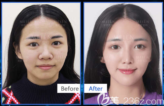 廣州美恩陳宏彬做的隆鼻和脂肪填充案例 廣州美恩陳宏彬做的隆鼻和脂肪填充案例