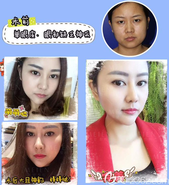 廣州美恩陳宏彬割雙眼皮案例 廣州美恩陳宏彬割雙眼皮案例