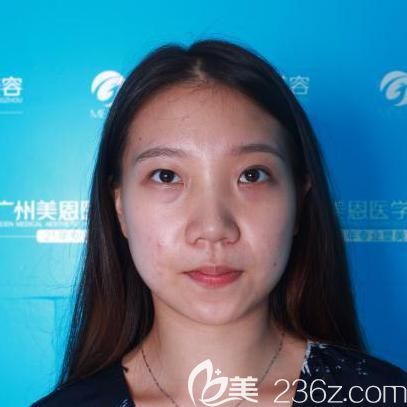 在廣州美恩整形術(shù)前照片 在廣州美恩整形術(shù)前照片