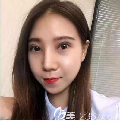廣州美恩陳宏彬醫(yī)生雙眼皮隆鼻案例效果圖 廣州美恩陳宏彬醫(yī)生雙眼皮隆鼻案例效果圖
