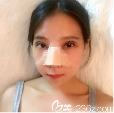 廣州美恩雙眼皮隆鼻案例術(shù)后5天 廣州美恩雙眼皮隆鼻案例術(shù)后5天