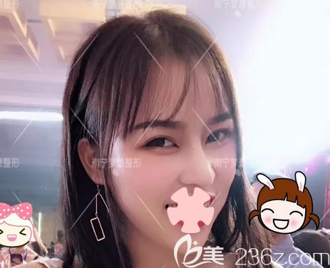 激光祛斑效果如何？上傳我在南寧夢(mèng)想整形做超皮秒激光祛斑恢復(fù)效果圖片