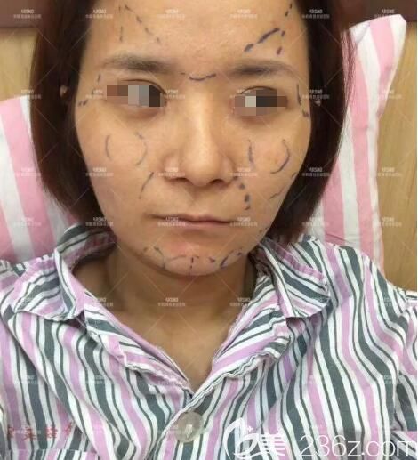 面診醫(yī)生設計納米脂肪膠立體填充手術方案