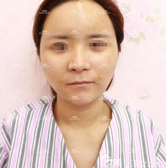 做完納米脂肪膠立體填充術后第二天恢復情況