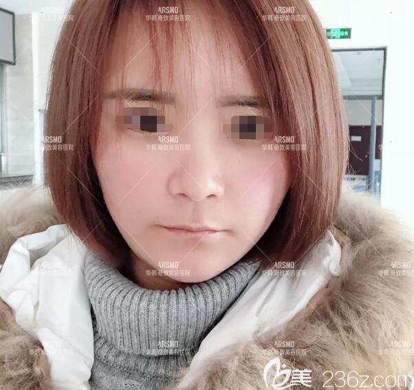 南京華韓奇致分享做納米脂肪膠立體填充術后一周恢復情況