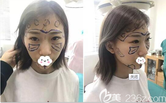 手術(shù)前額頭太陽穴蘋果肌凹陷干癟 手術(shù)前額頭太陽穴蘋果肌凹陷干癟