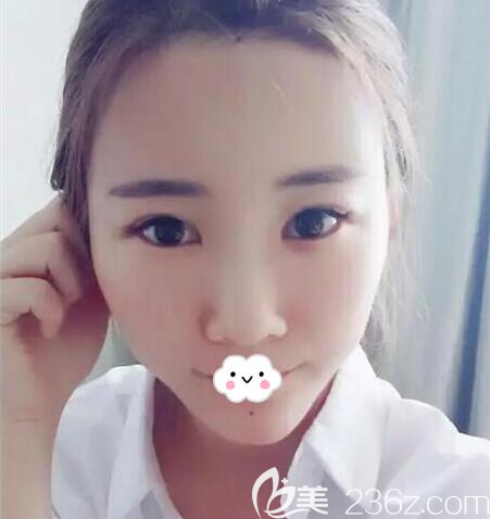 全面部脂肪填充后第5天的照片 全面部脂肪填充后第5天的照片