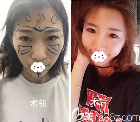 <!--<i data=20240703-sp></i>-->自體脂肪填充全面部術(shù)后對比 <!--<i data=20240703-sp></i>-->自體脂肪填充全面部術(shù)后對比