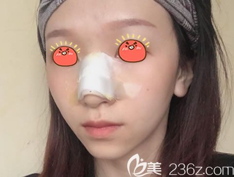 嘉興曙光醫(yī)院做駝峰鼻矯正效果
