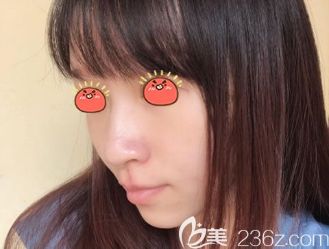 嘉興曙光整形醫(yī)院鼻綜合案例