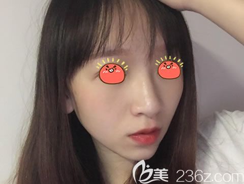 嘉興曙光高俊鼻綜合案例15天效果