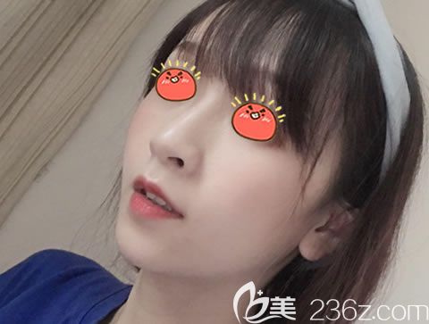 自打在嘉興曙光醫(yī)院做完鼻中隔和駝峰鼻綜合矯正后,朋友說(shuō)我的鼻子和臉終于協(xié)調(diào)了