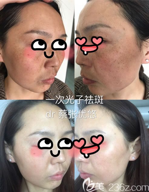 臺(tái)州維多利亞蔡張優(yōu)悠祛斑案例