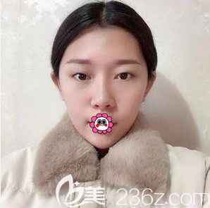 在北京藝星做眼綜合前樣子 在北京藝星做眼綜合前樣子