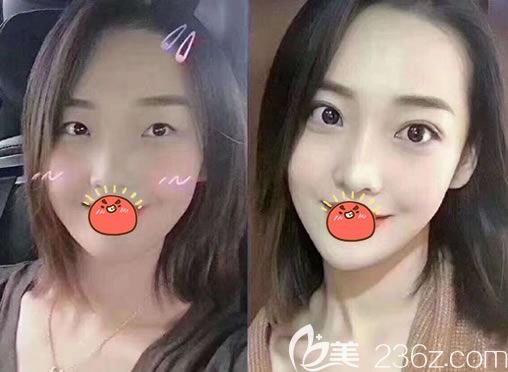 寧波薇琳醫(yī)美<!--<i data=20240703-sp></i>-->雙眼皮隆鼻案例 寧波薇琳醫(yī)美<!--<i data=20240703-sp></i>-->雙眼皮隆鼻案例