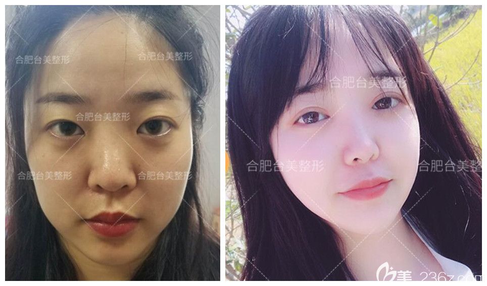 合肥哪家開雙眼皮好？公布合肥臺美麗格王新磊眼綜合案例效果對比圖