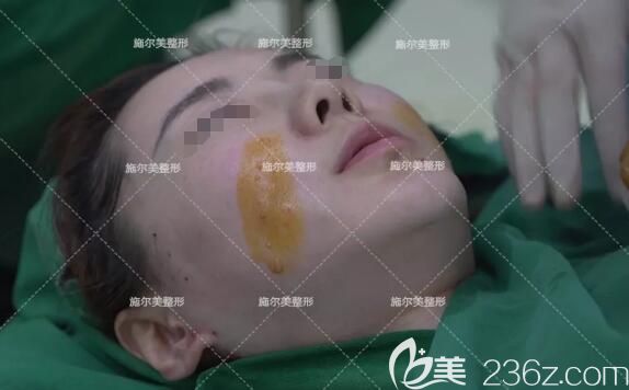 做線雕微整術(shù)前面部消毒 做線雕微整術(shù)前面部消毒